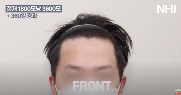 [뉴헤어] 모발이식 1800모낭(3600모) 1년 경과 사진 관련 이미지 3