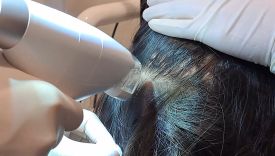 Female Hair Loss: What Symptoms Appear and How Should It Be Managed? image 4