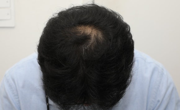 정수리 탈모 초기? 증상과 원인 그리고 치료 방법 관련 이미지 2