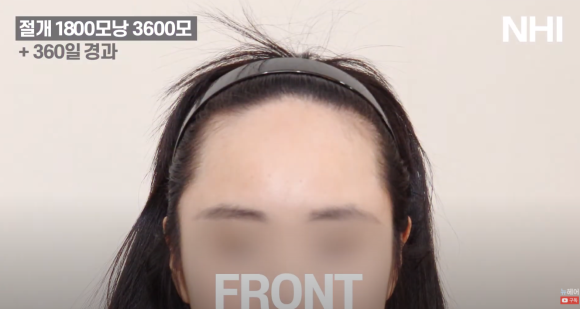 [뉴헤어] 여자 헤어라인교정 1800모낭 360일 이식 후기 관련 이미지 1