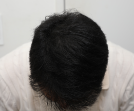 Why Are Crown Hair Transplants (Part-Line Hair Transplants) Slower to Show Results Than Other Areas? image 6