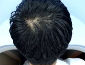 비수술탈모관리, 어떤 과정을 거치게 될까? 관련 이미지 3