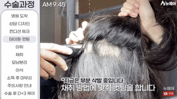 모발이식과정? A~Z 전부 공개합니다(동영상 포함) 관련 이미지 4