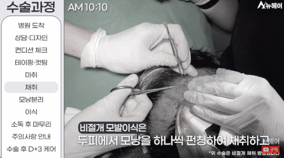 모발이식과정? A~Z 전부 공개합니다(동영상 포함) 관련 이미지 6
