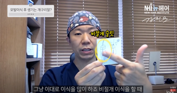 모발이식 개구리알의 진실 l 나도 생길까? 관련 이미지 5