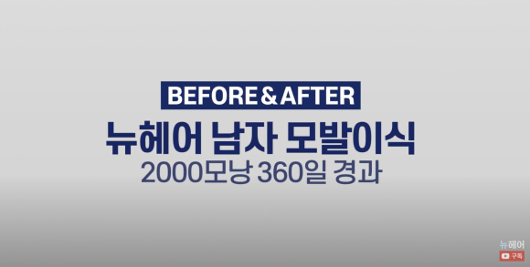 [뉴헤어] 남자 모발이식 2000모낭(4000모) 전후 비교 l 엠자이마 l 탈모 관련 이미지 1