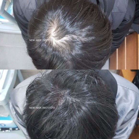 수술 없이 머리숱 많아 보이는 법? 두피문신(SMP)! 관련 이미지 3