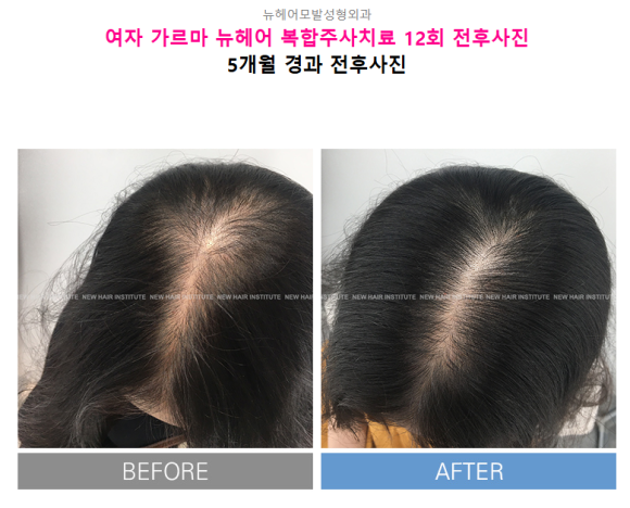 남자 탈모 vs 여자 탈모, 치료법이 다른 3가지 이유 관련 이미지 7