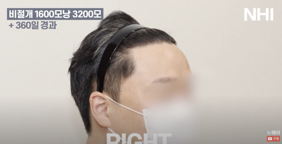 넓은 이마 탈모 모발이식 후기 l 전/후 사진 보기 1600모낭 l 뉴헤어 관련 이미지 5