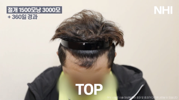 모발이식을 통한 엠자라인 극복 l 남자 이마축소 l 절개 모발이식 관련 이미지 7