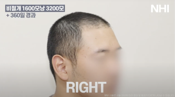 모발이식 비절개 1년 후기 전후사진 1600모낭 관련 이미지 3