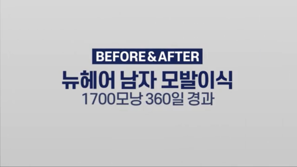 모발이식으로 엠자라인 벗어난 1년 후기 사진 l 1700모낭 이식 l 유전성탈모 관련 이미지 1