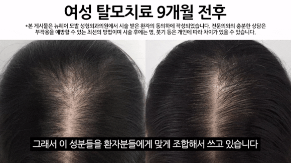 탈모 치료, 지금 시작해야 하는 이유 관련 이미지 1