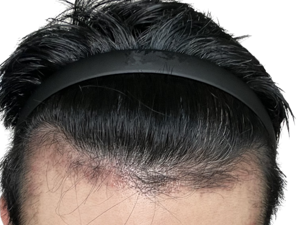 모발이식실패? 머리카락이 다시 빠지는 이유와 대처법 관련 이미지 1