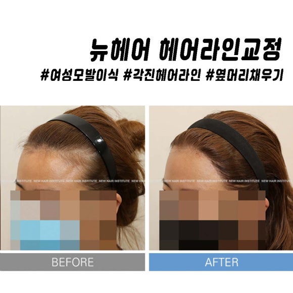 여성 헤어라인 모발이식 고민이라면 관련 이미지 13