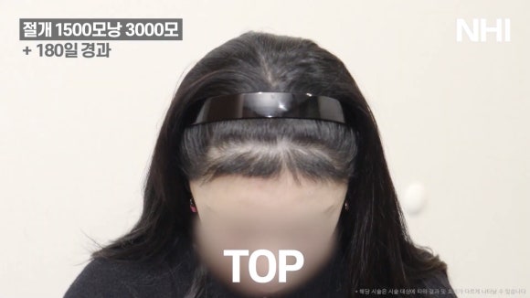 이마축소술 흉터제거 헤어라인 재수술 l 여성 모발이식 관련 이미지 7