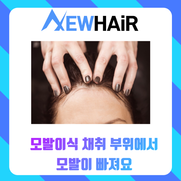 모발이식암흑기 그냥 지나갈 수 있을까? 관련 이미지 5