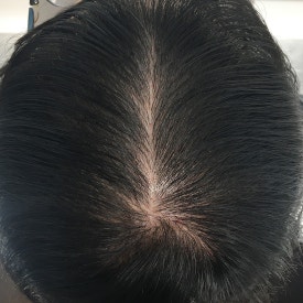 Hair Loss Treatment: Different Strategies by Area (When Combination Treatment Is Used) image 5