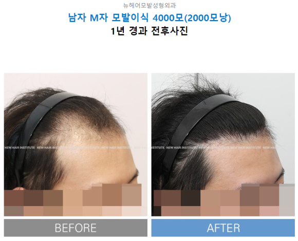 모발이식 후 탈모약, 먹는다? 안먹는다? 탈모의사가 알려드립니다 관련 이미지 7