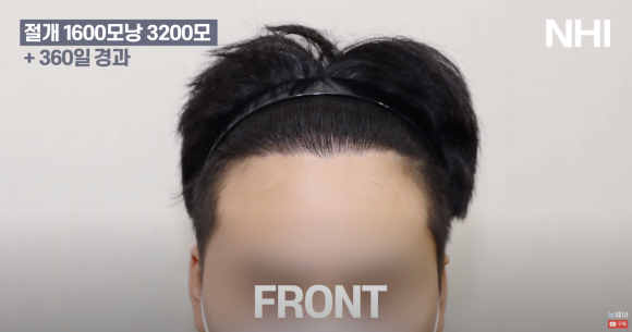 남자 모발이식 1600모낭 1년 지난 후 사진 경과 후기 관련 이미지 3
