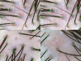 Why Hair Loss Diagnoses Differ by Clinic: What Are the Differences? image 1