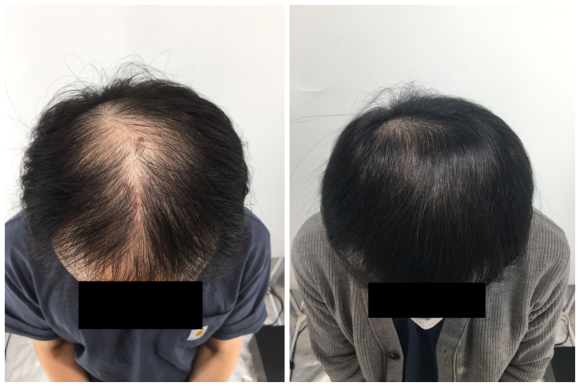탈모주사치료, 관련 이미지 2