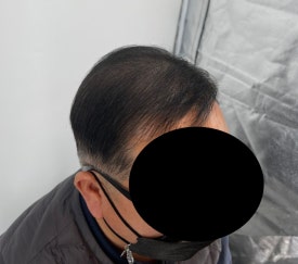 두피문신후기, 60대 남성 사례 전부 공개합니다 관련 이미지 13