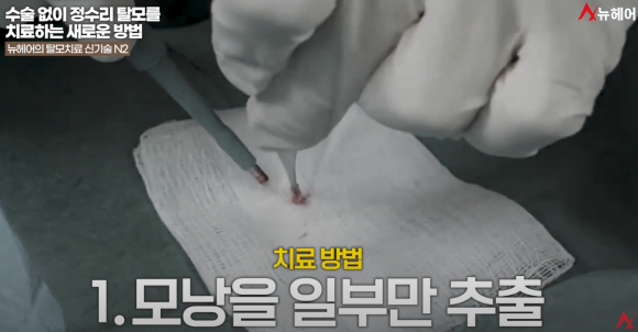 탈모약 없이도 탈모 극복? 7가지 탈모치료 가이드 관련 이미지 13