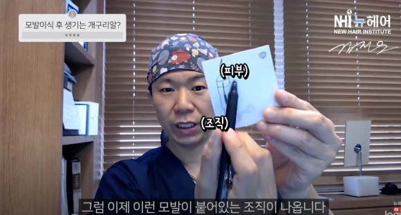 모발이식 개구리알의 진실 l 나도 생길까? 관련 이미지 4