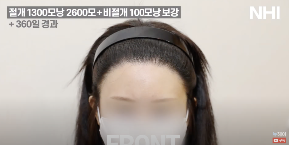 여자 모발이식 재수술 헤어라인교정 l  1300모낭 1년 경과 사진 l 3차 재수술 관련 이미지 3