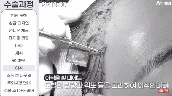 모발이식과정? A~Z 전부 공개합니다(동영상 포함) 관련 이미지 10