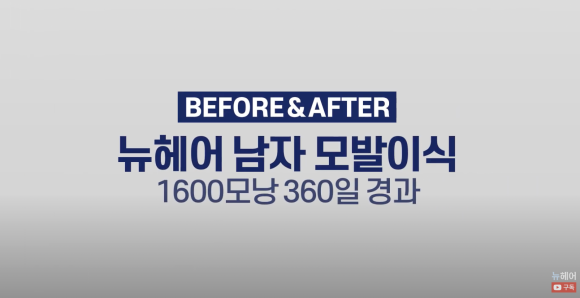 넓은 이마 탈모 모발이식 후기 l 전/후 사진 보기 1600모낭 l 뉴헤어 관련 이미지 1