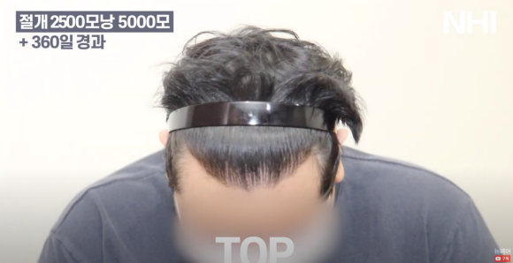 넓은 이마 모발이식 l 탈모 모발이식 후기 사진 관련 이미지 7