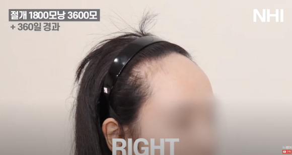 [뉴헤어] 여자 헤어라인교정 1800모낭 360일 이식 후기 관련 이미지 3
