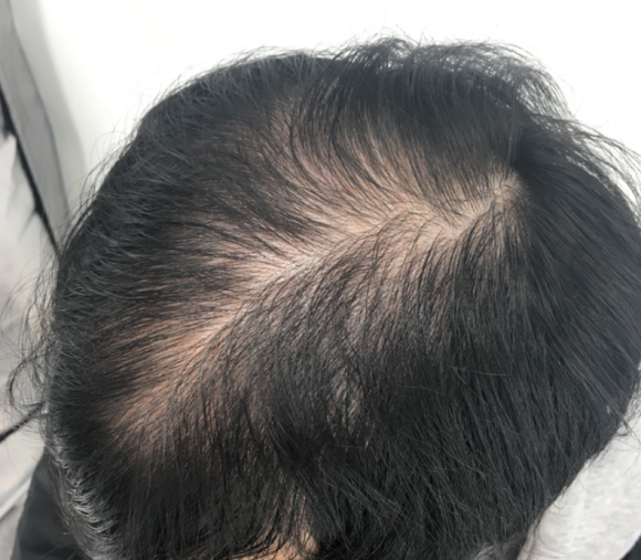 Hair Loss Treatment: Different Strategies by Area (When Combination Treatment Is Used) image 2
