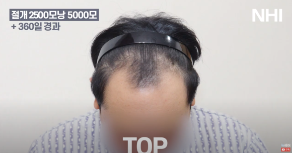 넓은 이마 모발이식 l 탈모 모발이식 후기 사진 관련 이미지 6
