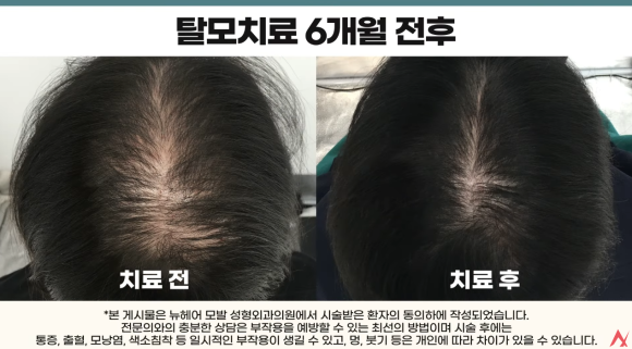 연예인들이 선택하는 탈모치료법? 가발에서 모발이식까지 관련 이미지 9