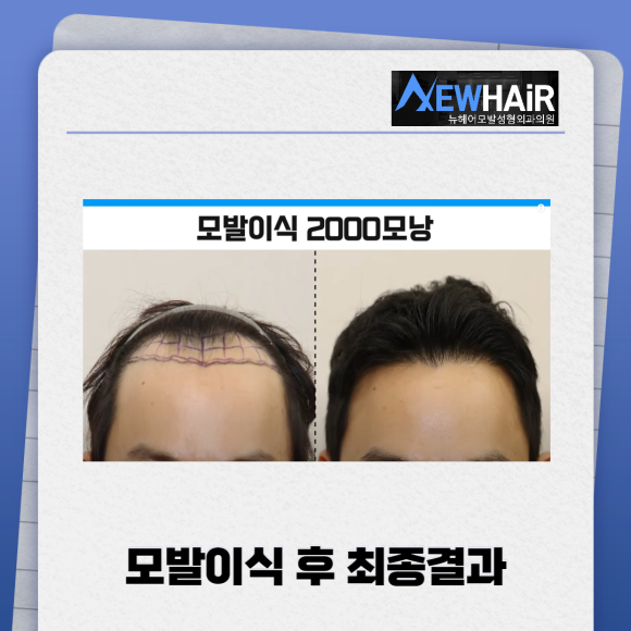 모발이식 m자 탈모커버 확실하게 관련 이미지 5