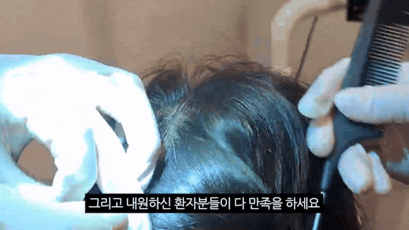 여성 탈모 치료, 맞춤형 치료법 정리 관련 이미지 4