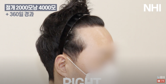 [뉴헤어] 남자 모발이식 2000모낭(4000모) 전후 비교 l 엠자이마 l 탈모 관련 이미지 5