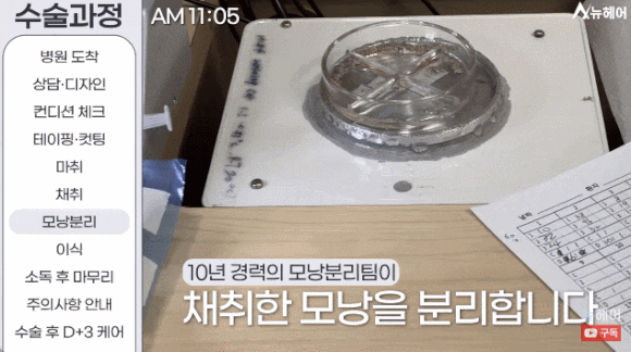 모발이식과정? A~Z 전부 공개합니다(동영상 포함) 관련 이미지 8