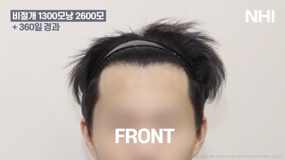 모발이식 전후 사진 l 1년 후ㅣ뉴헤어 1300모낭 관련 이미지 2