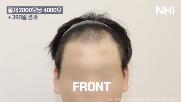 M자탈모(엠자탈모) 모발이식 1년 후 모습 공개 l 2000모낭(4000모) 관련 이미지 2