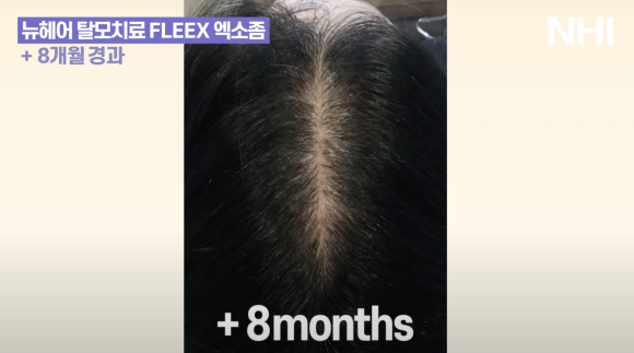 가르마 탈모치료(모낭주사) 8개월 경과 후기 사진 l  탈모치료 관련 이미지 4