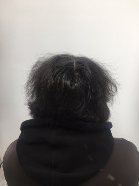 남성형 탈모 치료, 6개월 만에 이루어낸 변화 대공개 관련 이미지 10