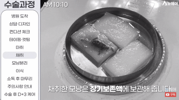 모발이식과정? A~Z 전부 공개합니다(동영상 포함) 관련 이미지 7