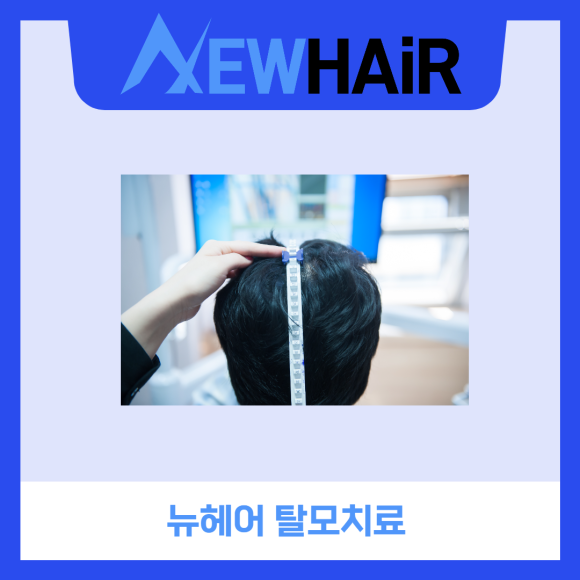 탈모약 효과 제대로 보려면? 관련 이미지 7