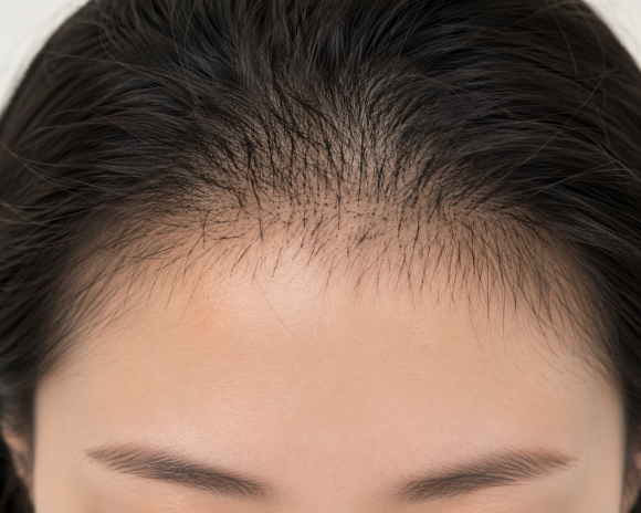 Is a Stubbly Hairline a Good Sign of Hair Growth? image 2