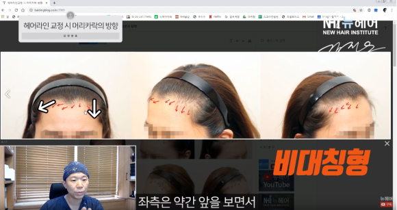 나도 몰랐던 머리카락 방향 찾기 l 모발이식 l 헤어라인교정 관련 이미지 3