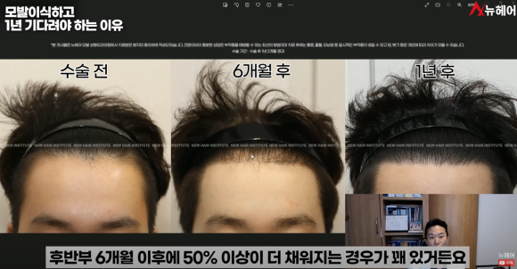 모발이식경과 1년을 기다려야 하는 이유 관련 이미지 10